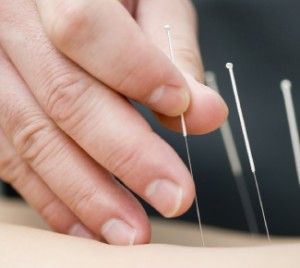 Dry Needling